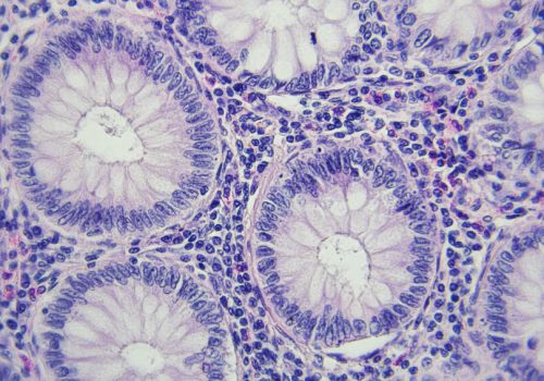 Colon cancer section Colon cancer section